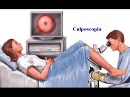 colposcopia